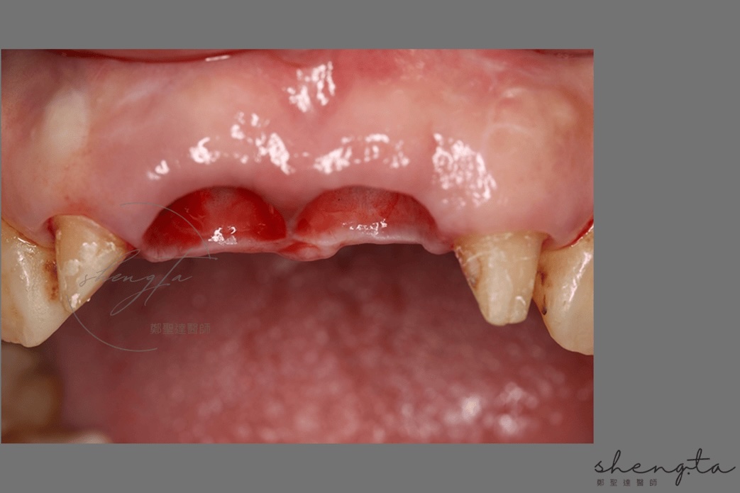 數位植牙過程 - 植體周圍的軟組織癒合良好