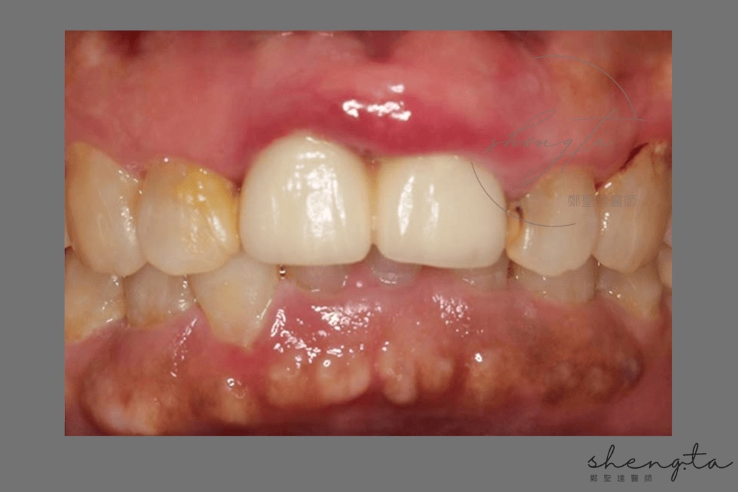 植體周圍炎治療前後比較 - 術前口內照