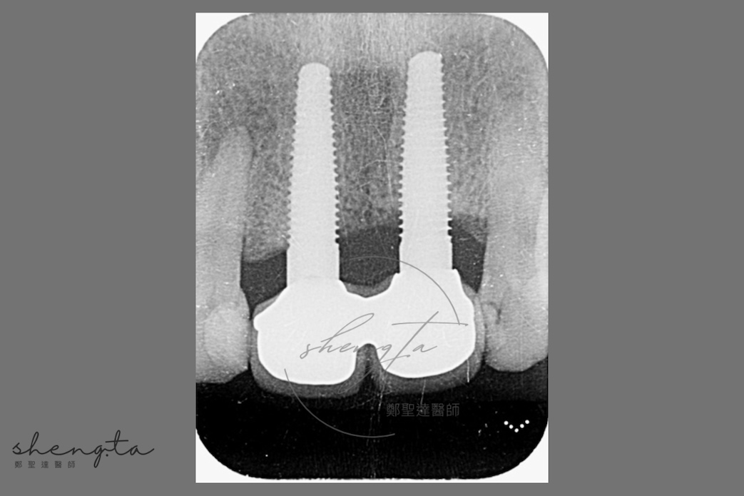 植體周圍炎治療前後比較 - 術前根尖X光片