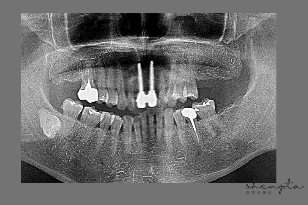 植體周圍炎治療前後比較 - 術前環口X光片