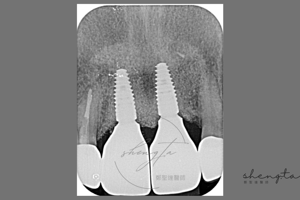 植體周圍炎治療前後比較 - 術後根尖X光片