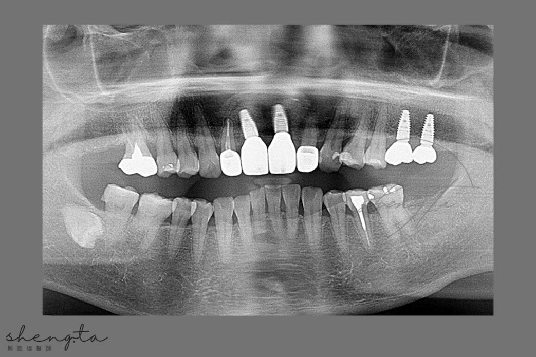 植體周圍炎治療前後比較 - 術後環口X光片