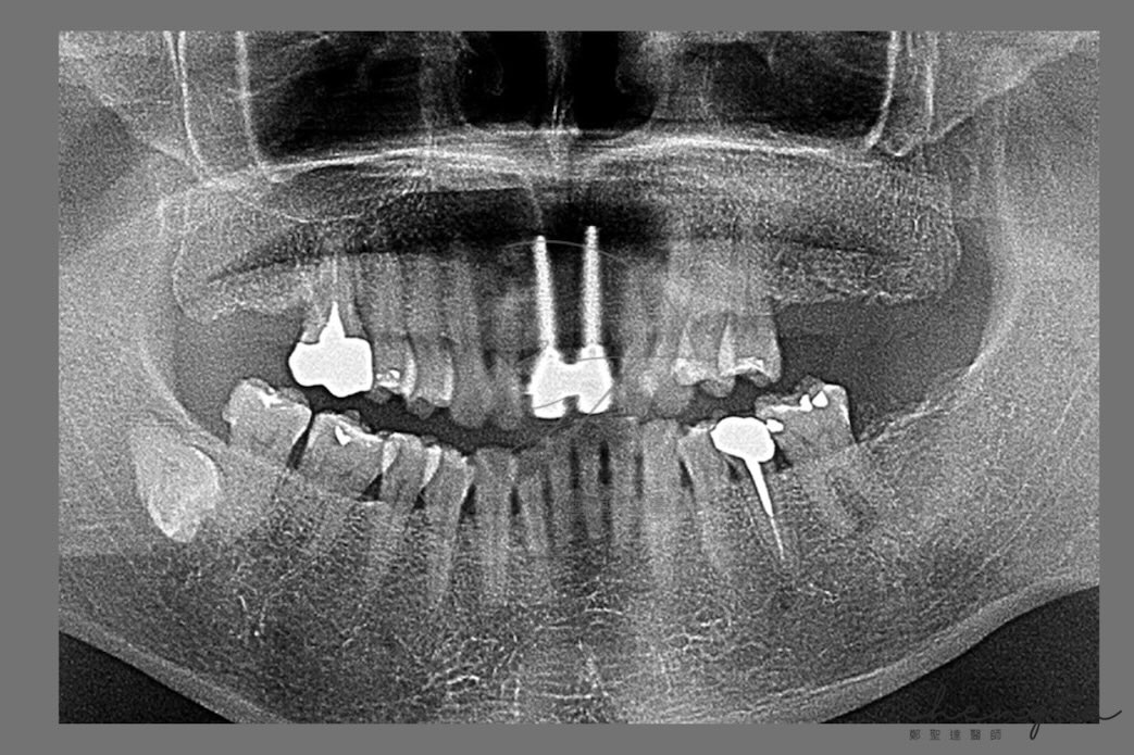 植體周圍炎治療前初診環口X光片