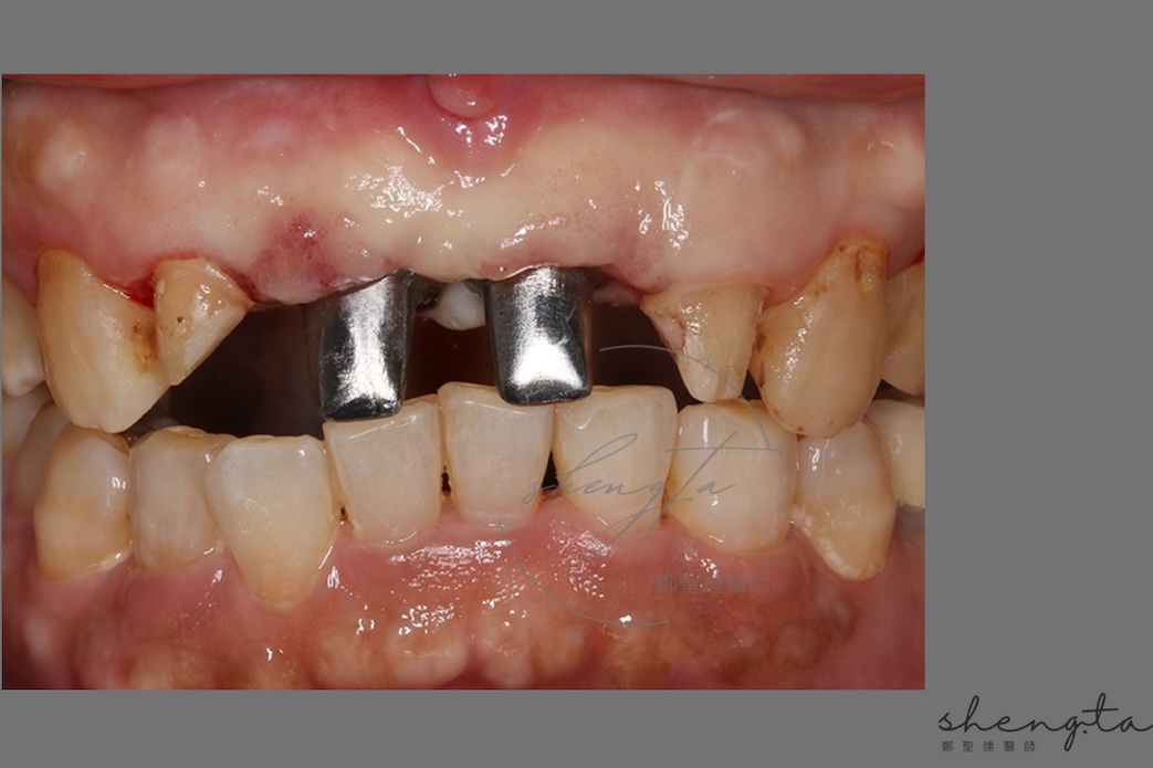 數位植牙過程 - 置放客製化金屬支台齒