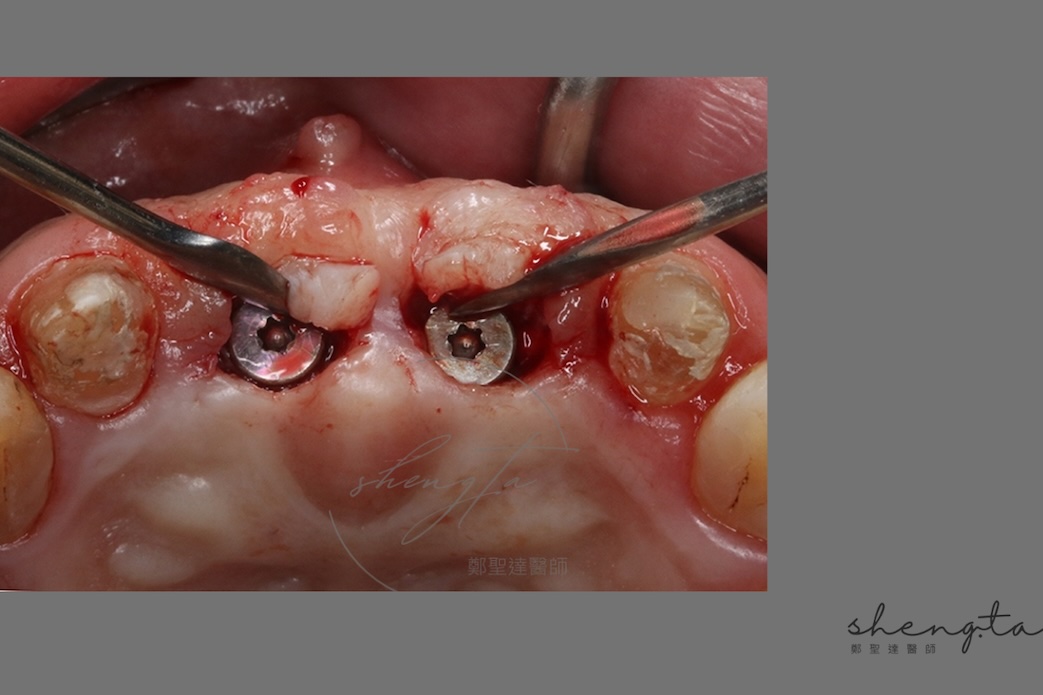 水雷射微創植牙二階手術過程 - 鎖上癒合基台