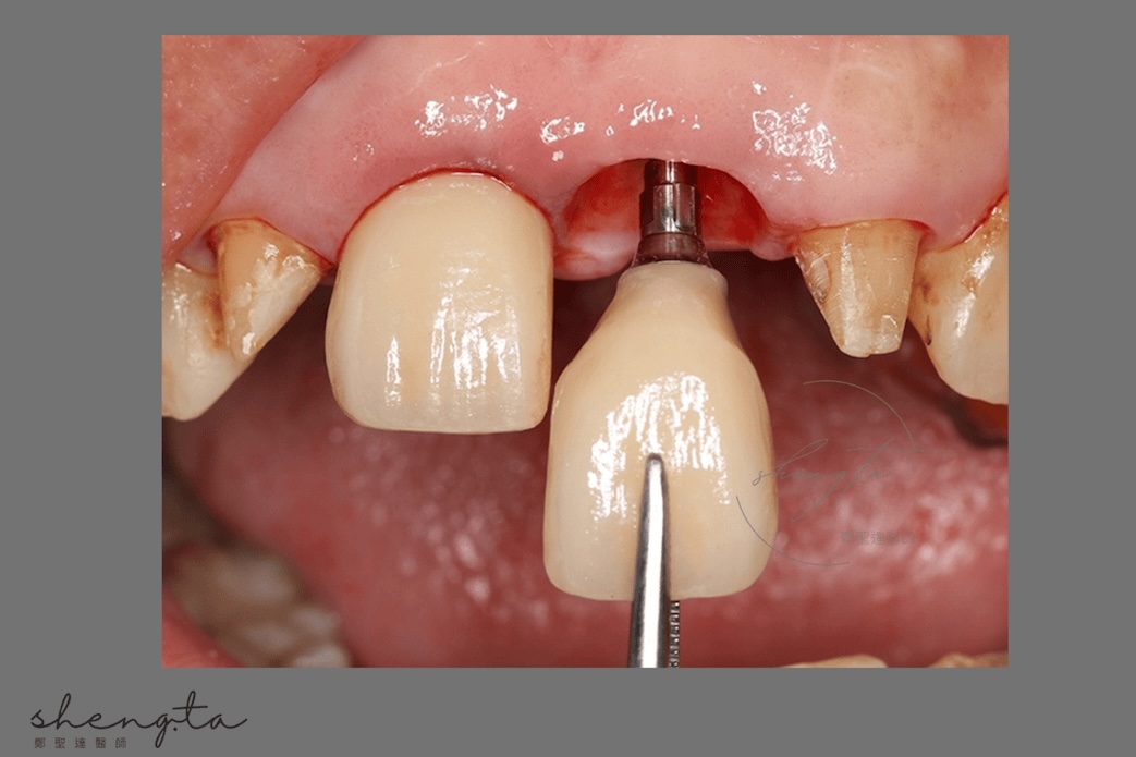數位植牙過程 - 鎖入正式全瓷冠假牙