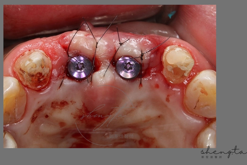 水雷射微創植牙二階手術過程 - 鎖入癒合帽並縫合傷口