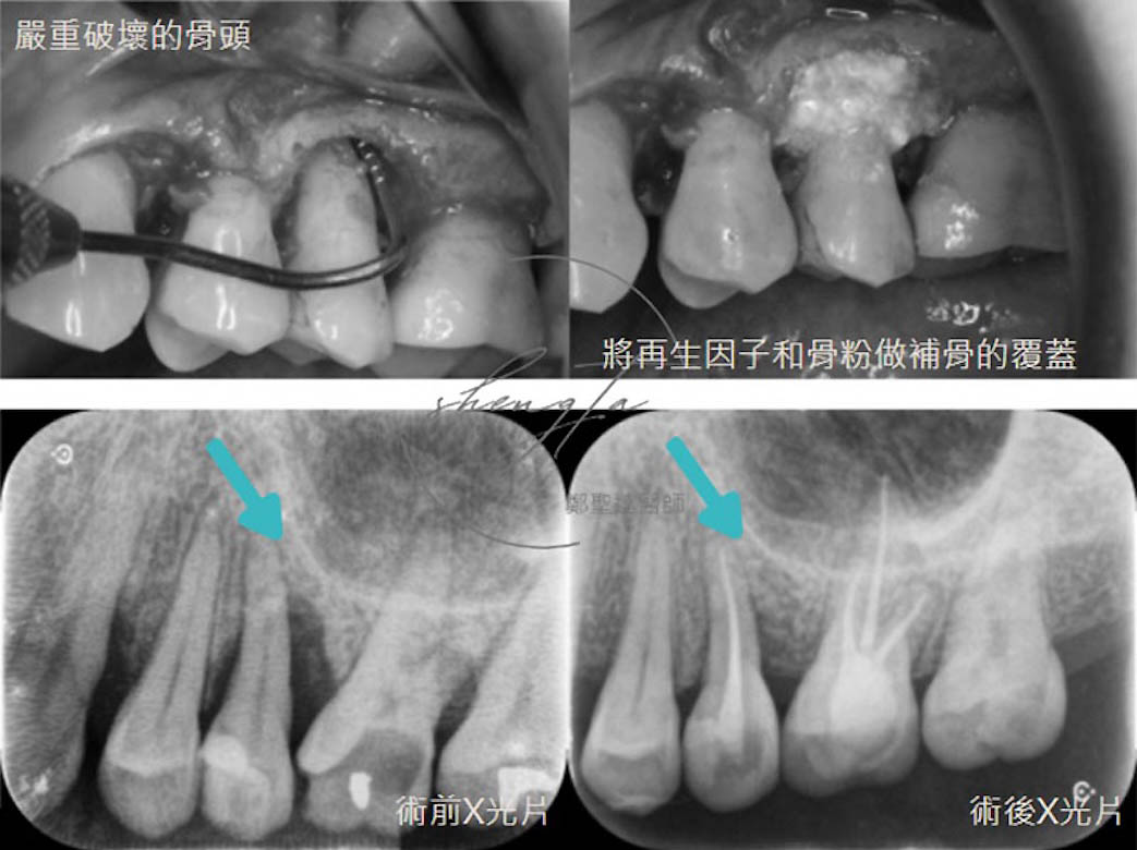 牙周再生手術案例一：手術過程與術前術後對比