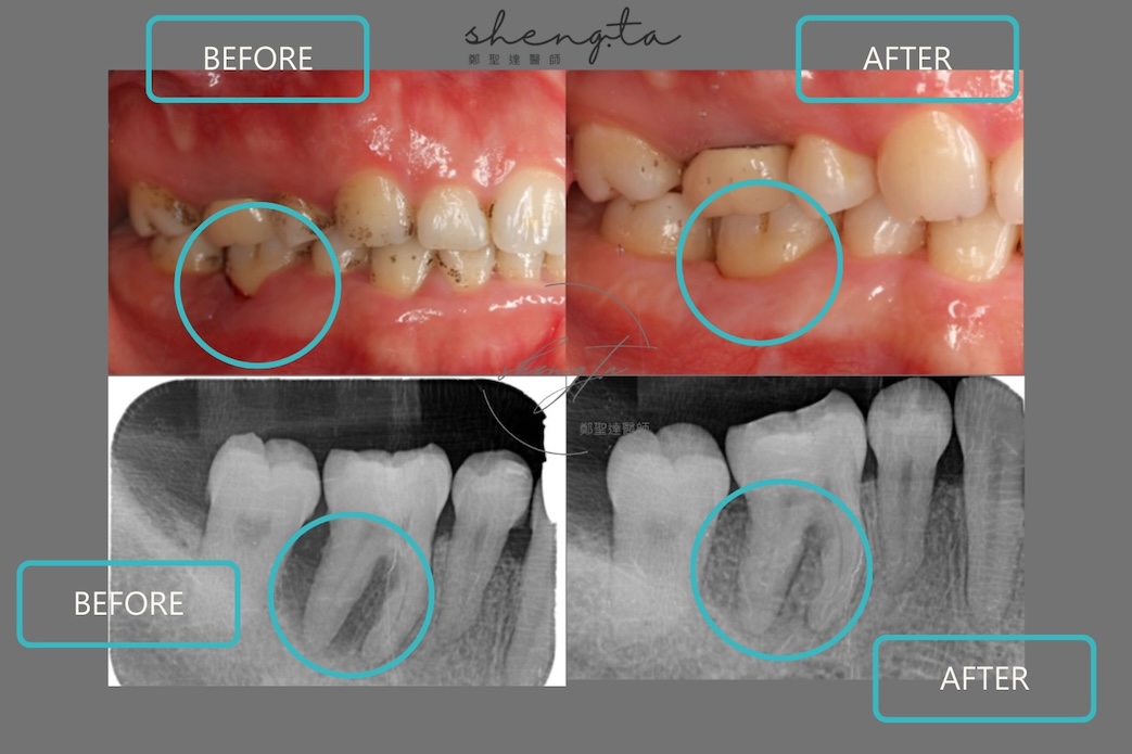 牙周再生手術案例二：術前術後對比