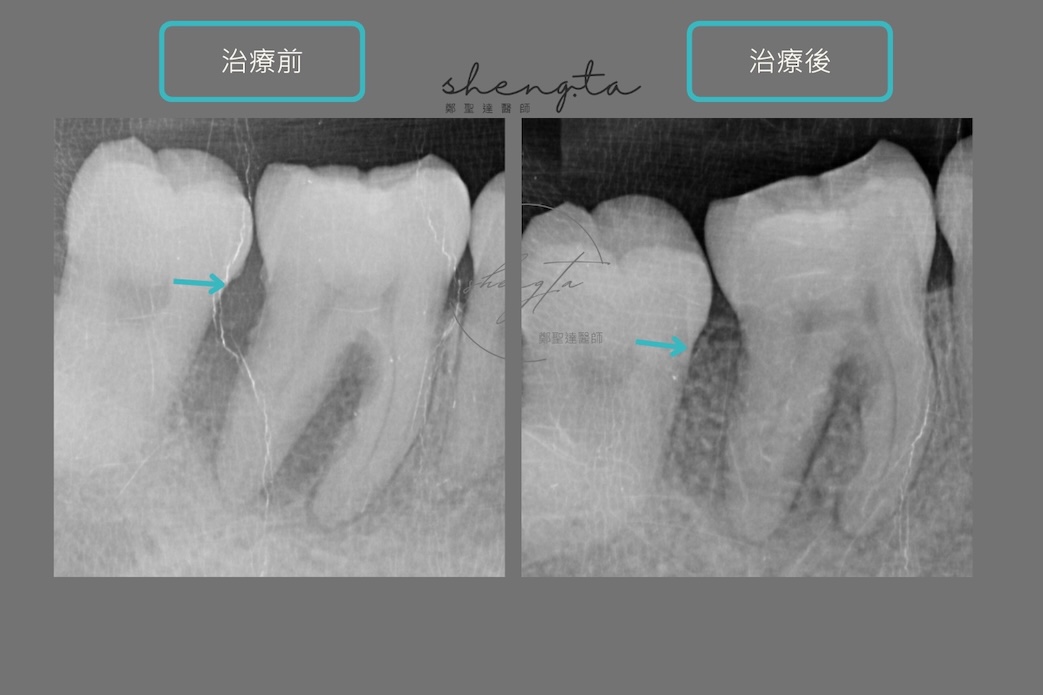 嚴重牙周病治療前後根尖X光片對比