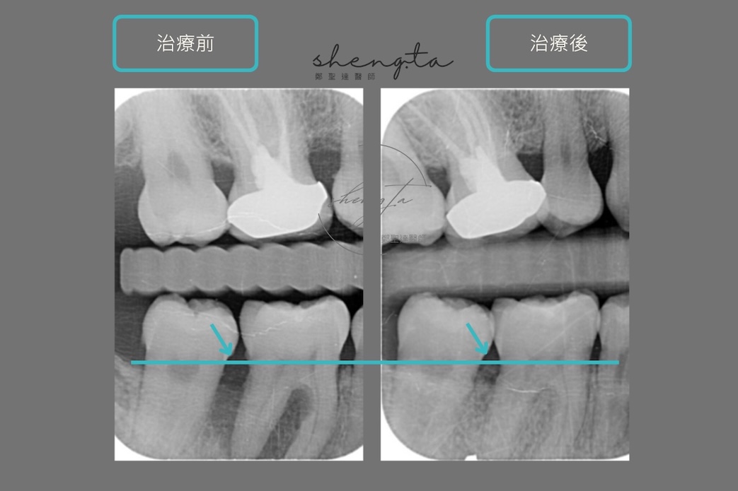 嚴重牙周病治療前後根尖X光片對比