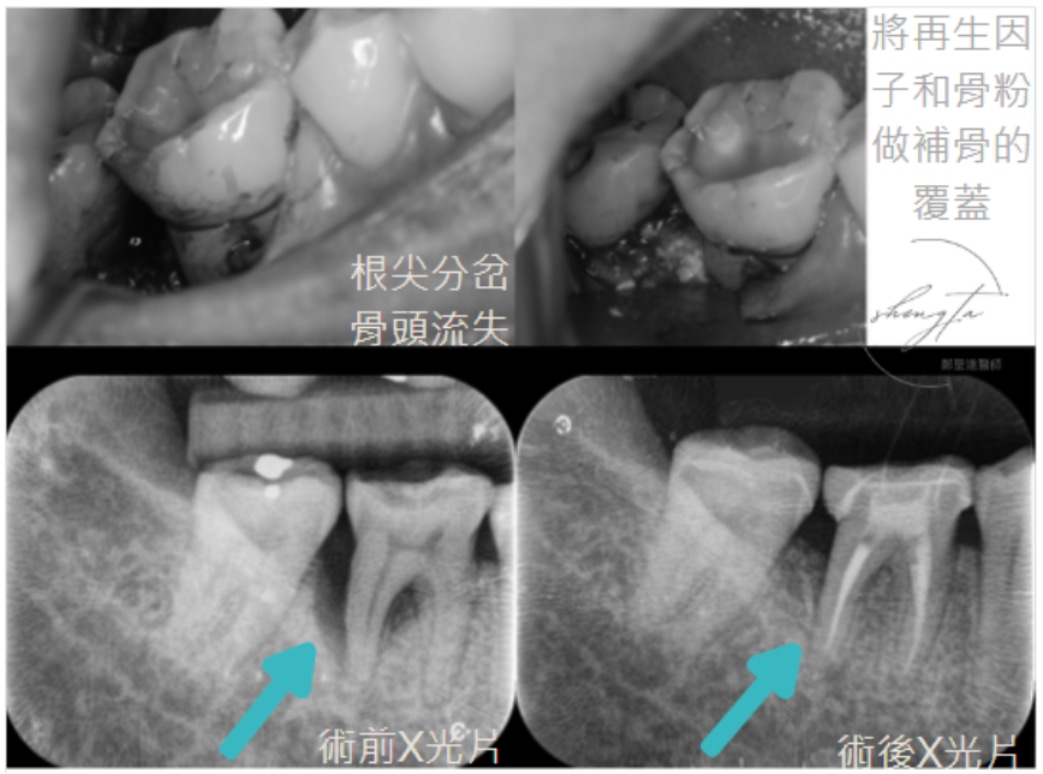 術前齒槽骨缺損嚴重,透過牙周再生手術補骨重建,牙齒穩定保留