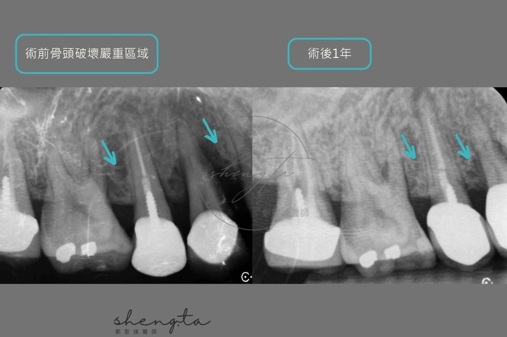 術前骨頭破壞與牙齒搖動狀況,經水雷射微創治療與牙周再生手術補骨,齒槽骨恢復良好