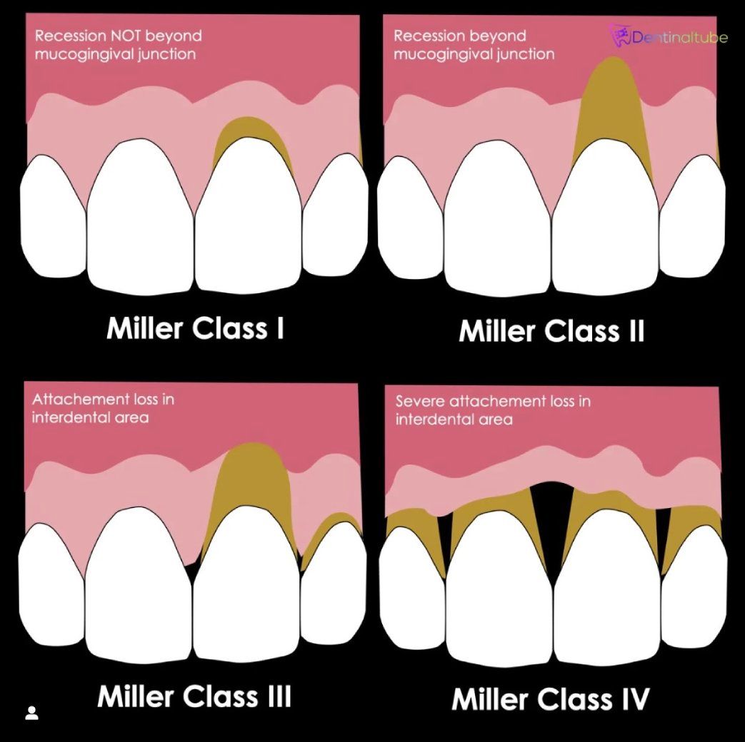 Miller牙齦萎縮分類插圖,分為 I 至 IV 級