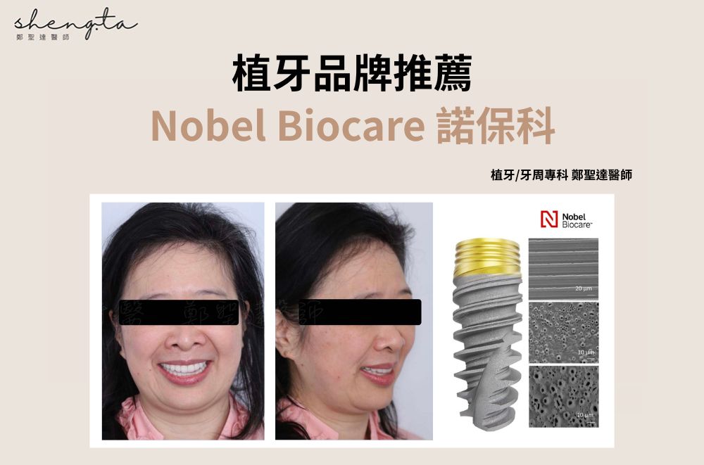 諾保科植體-Nobel-Biocare-瑞典植牙品牌-台北植牙推薦-鄭聖達醫師