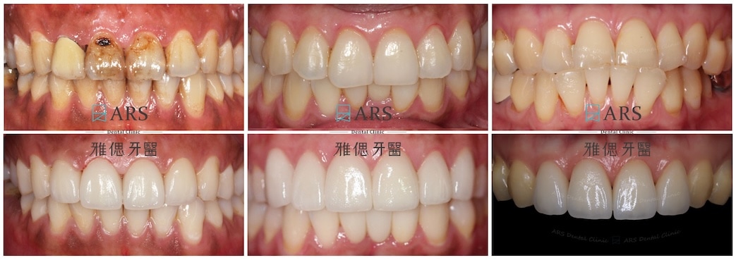 陶瓷貼片療程前後牙齒近照對比