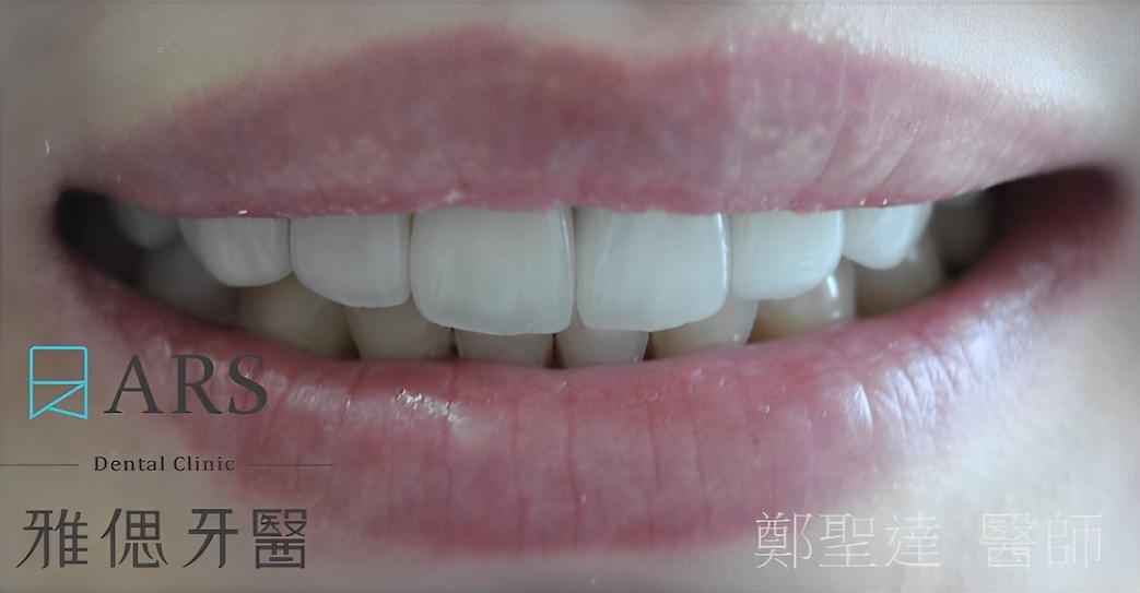 陶瓷貼片療程後笑容近照