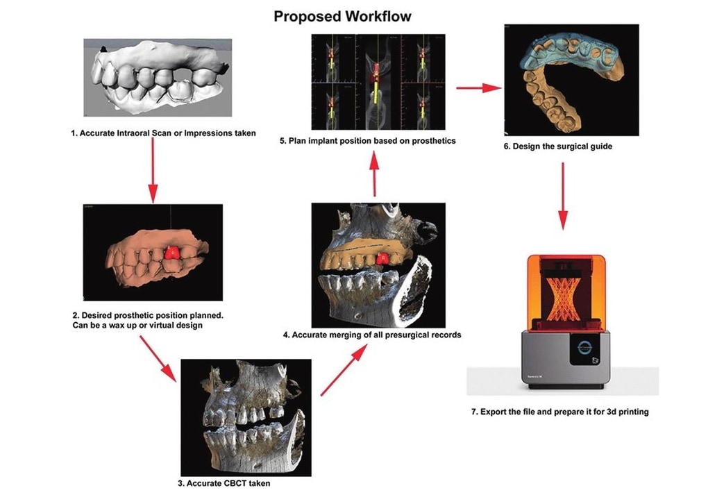 數位植牙的完整工作流程圖,包含口掃、拍攝CBCT、資料合併、假牙與植體規劃、導引板設計及3D列印