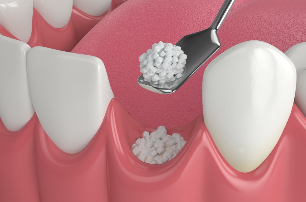 植牙補骨-補骨失敗-鼻竇增高術-水雷射植牙-台北植牙-推薦-鄭聖達醫師