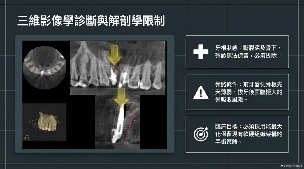 右上正中門牙牙根斷裂與薄唇側骨板三維影像