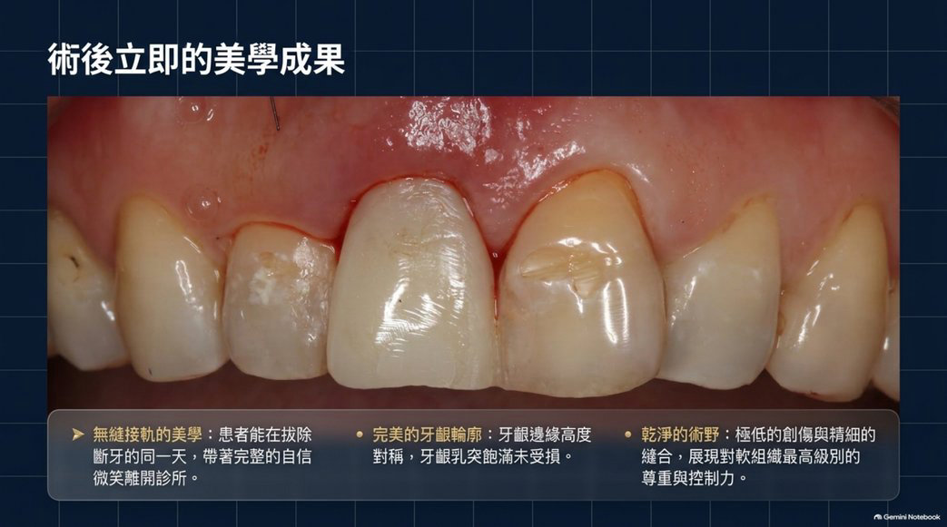 右上正中門牙立即植牙與臨時假牙術後即時外觀