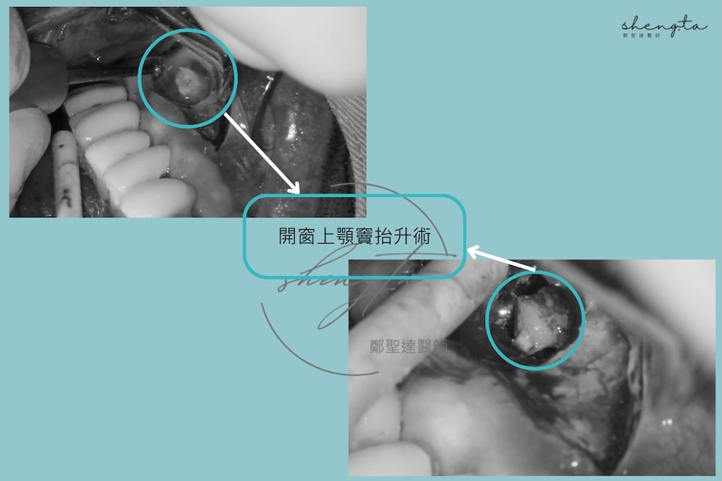 上顎後牙骨量不足接受開窗式鼻竇增高與植牙補骨治療