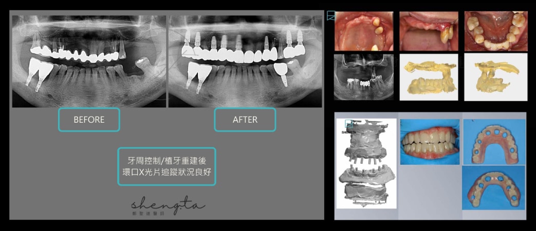 嚴重牙周病分區植牙前後 X 光比較，以及 All-on-6 全口重建的術前資料與臨時固定牙橋