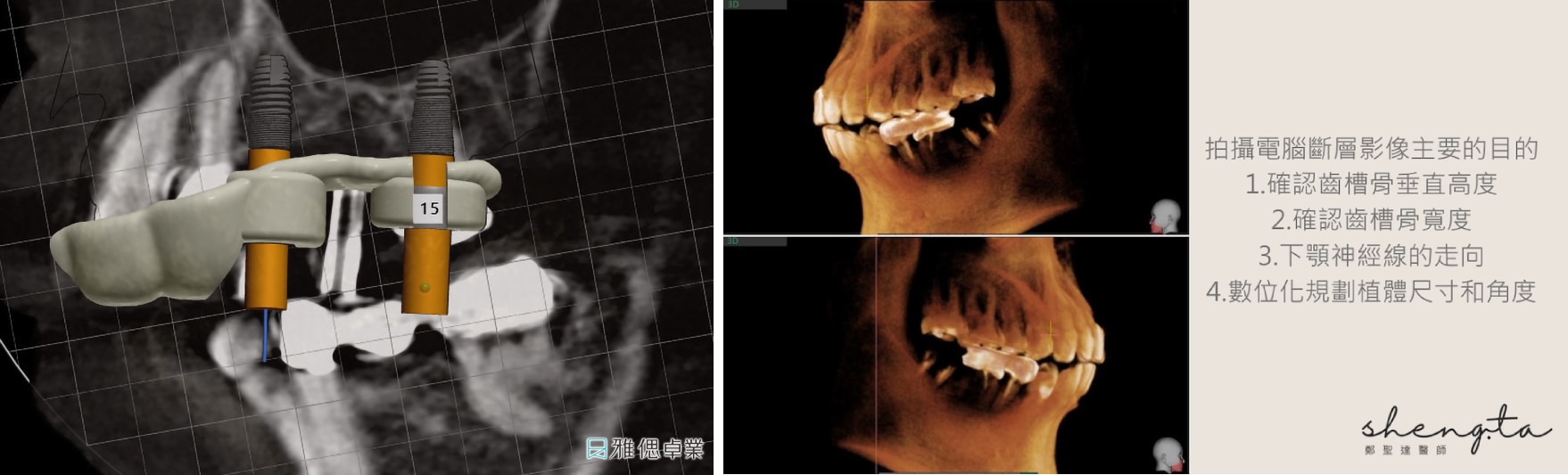 數位植牙導引板與 CBCT 植體位置規劃，評估齒槽骨條件與植體角度