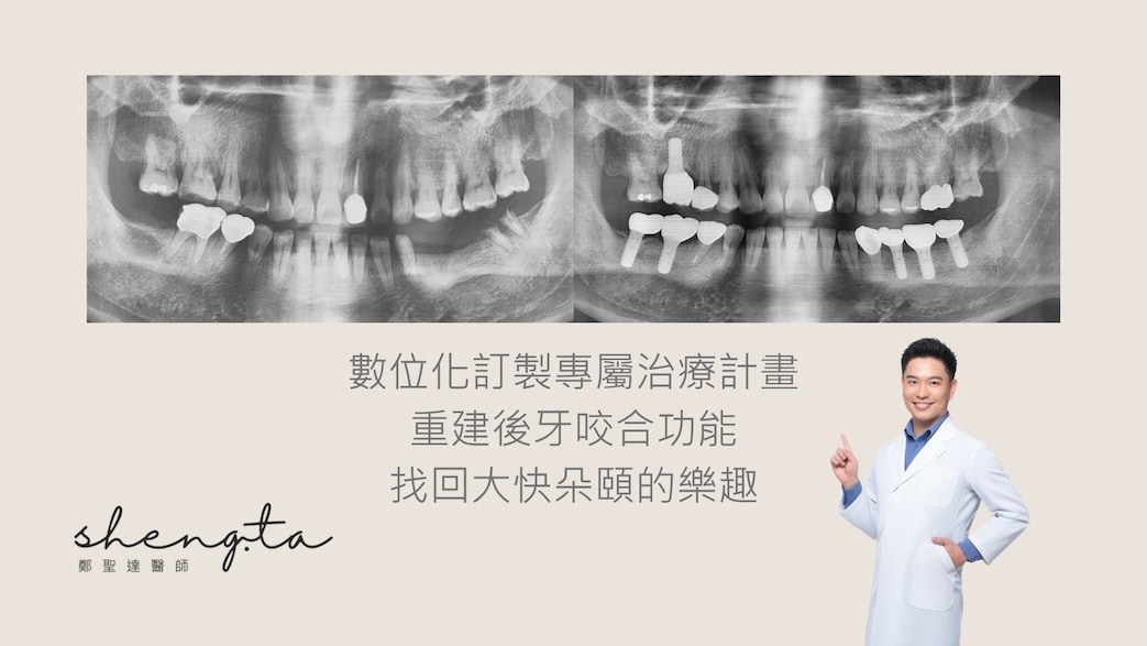 牙橋脫落後使用CBCT與數位植牙導板完成後牙重建